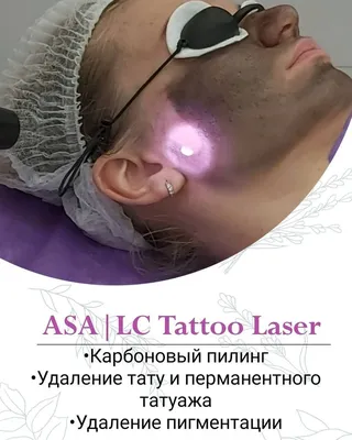 Карбоновый пилинг - процедура лазерный карбоновый пилинг: цены в Киеве |  Клиника Gold Laser