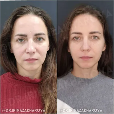 Лазерный пилинг для лица - цена процедуры в Москве, фото до и после |  Доктор Мезо