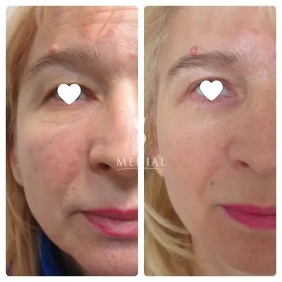 Фотографии до и после лазерного омоложения кожи Fraxel, проводим в клинике  Premium Aesthetics