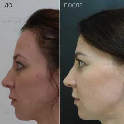 Лазерный пилинг (дермабразия) кожи лица: противопоказания, уход, фото до и после  процедуры