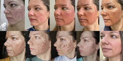 Лазерная шлифовка лица в Москве: цены, фото до и после, отзывы | Стоимость  лазерной шлифовки лица в клинике Seline