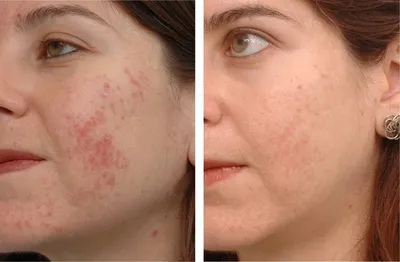 Лазерный пилинг кожи лица в Алматы, цена, отзывы. Стоимость пилинга лазером  от MLC