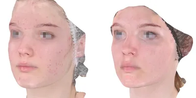 Акне на лице лечение фото до и после. Акне фото после лечения. Акне до и после  лечения фото.