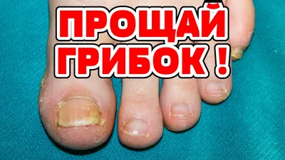 Грибок ногтей на ногах: что это, причины, сколько стоит лечение, лекарства  от онихомикоза
