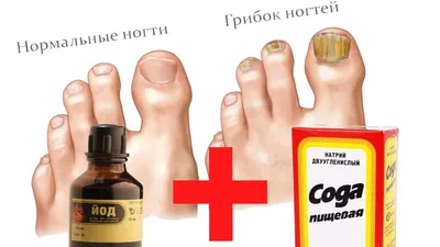 СОДА + ЙОД Лечение грибка на ногах / Грибок на ногтях лечение в домашних  условиях / Как лечить - YouTube