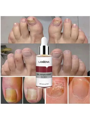 LANBENA От грибка ногтей 15 ml