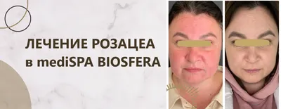 Лечение розацеа | MediSPA центр BIOSFERA