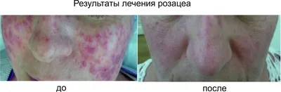 Розацеа на лице - лечение в Москве, причины, диагностика