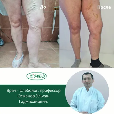 Лечение варикоза в Новосибирске лазером (ЭВЛК) — цены в центре лазерной  хирургии Duet Clinic