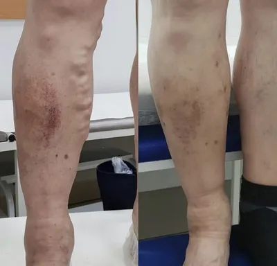 ЭВЛК - Эндовенозная лазерная коагуляция вен цена в Москве, лечение варикоза  вен на ногах лазером в клинике Армедика
