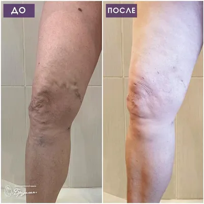 Лазерное лечение варикоза с Biolitec - Как будет выглядеть нога после  лечения варикозной болезни методом ЭВЛК? На фото пример до и через 3 месяца после  лечения варикоза: | Facebook