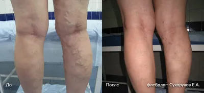 Эндовенозная лазерная коагуляция вен (ЭВЛК) | Цена лечения варикоза вен на  ногах лазером