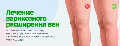 Лечение вен лазером Калининград | ЭЛВК