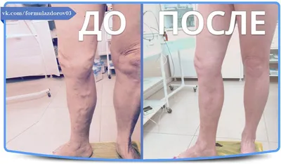 Лечение варикоза вен на ногах лазером - цены в Москве