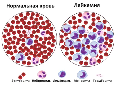 лейкемия | GreenPost