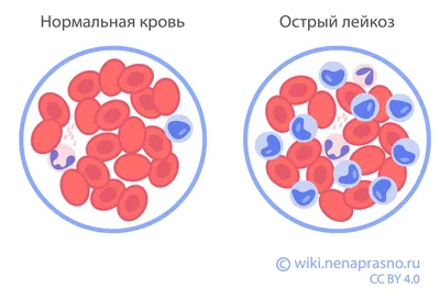 Синдром Свита — Википедия