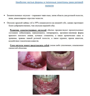 Зубной абсцесс: симптомы, лечение