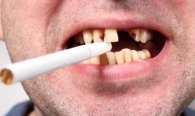 Свищ на десне у ребенка: фото, лечение, что делать | Dental Art