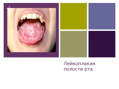 Лариса Владимировна on Instagram: \"МЯГКАЯ ЛЕЙКОПЛАКИЯ: ЧТО ЭТО ТАКОЕ?  ⠀⠀⠀⠀⠀⠀⠀⠀⠀⠀⠀⠀⠀⠀⠀⠀⠀⠀⠀⠀⠀⠀⠀⠀⠀⠀⠀ Это результат хронической травмы слизистой  оболочки полости рта ...