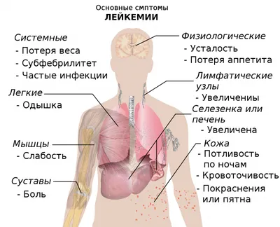 Лейкоз. Симптомы у детей | Онкология — не приговор | Дзен