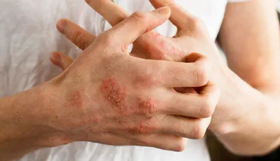 Аллергический васкулит кожи: симптомы, диагностика, лечение аллергического  васкулита кожи - Аллергология и иммунология – Государственная больница НКЦ  №2 (ЦКБ РАН)
