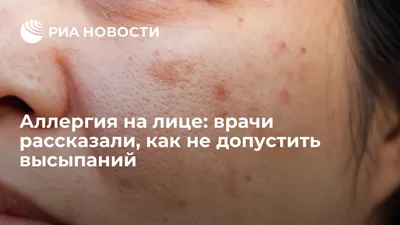 Аллергия на лекарства: причины, виды, симптомы, диагностика и лечение  аллергии на лекарства в Москве - сеть клиник «Ниармедик»