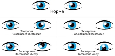 Что такое амблиопия (ленивый глаз): лечение в Дом Оптики