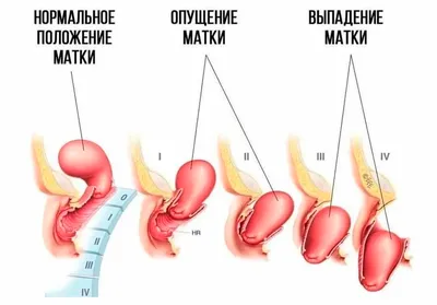 Фото до и после — VASER-липосакция — клиника Seline