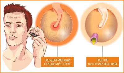 Хейлопластика в Москве | Цены на увеличение губ хирургическим путем