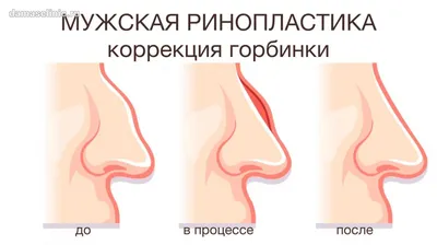 Восстановление носа после неудачной мужской ринопластики. Фото до и после