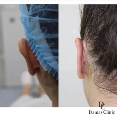 Фото до и после — VASER-липосакция — клиника Seline