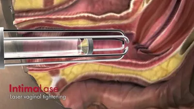 Передняя и задняя леваторопластика влагалища в Москве, цены на операции в  клинике «Он Клиник»