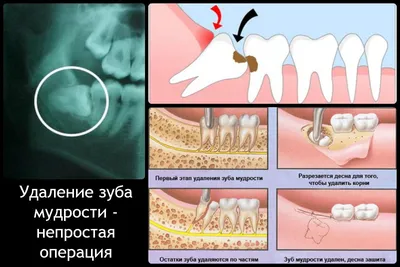 Удаление ретинированных зубов в Краснодаре в Кул Клиник