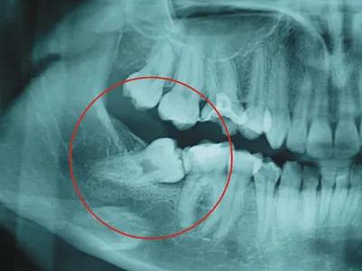 Удаление ретинированного (непрорезавшегося) зуба мудрости - «2 сложных  случая удаления нижних «лежачих» зубов мудрости🦷Какие могут быть  последствия и стоят ли того эти мучения.» | отзывы
