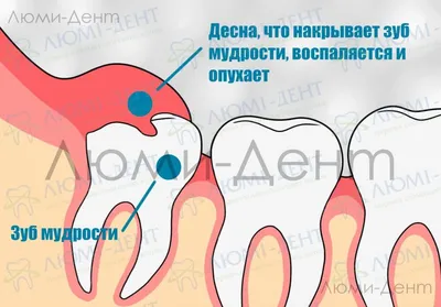 Удаление зуба мудрости сверху, снизу: показания, трудности, особенности  удаления воьмерки