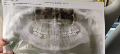 Как удалить ретинированный зуб? | Стоматология Ас-Стом | Санкт-Петербург  (СПб)