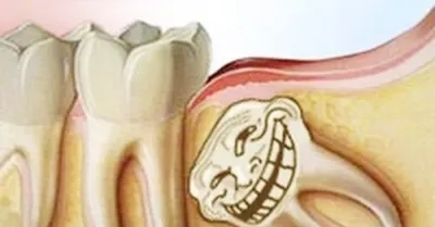 СТОМАТОЛОГИЯ Ростов on Instagram: \"Почему зубы мудрости растут  горизонтально? 🦷 ⠀ Такое явление называется «дистопией».☝️ ⠀ Есть  несколько причин, почему третьи моляры могут расти неровно – помимо того,  что они уже стали