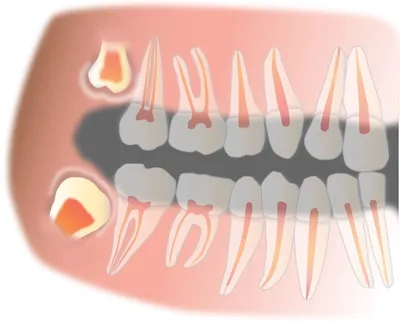 pro.zuby - Случай из практики #prozubyrezultat Пациент обратился с жалобами  😢 на периодические ноющие боли, дискомфорт при пережёвывании пищи,  застревание пищи. На рентгенограмме я увидела: 1. Некачественно  запломбированные каналы в «причинном» зубе