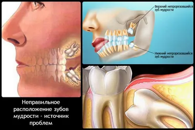 Нужно ли удалять зуб мудрости, когда лечить, а когда удалять?