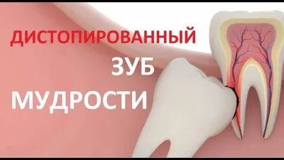 Удалить зуб мудрости в Москве в клинике Дентал гуру - цены, отзывы пациентов