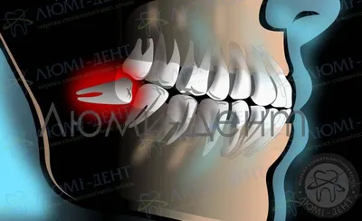 Почему зуб мудрости лежит горизонтально? — НовоДент - сеть стоматологий