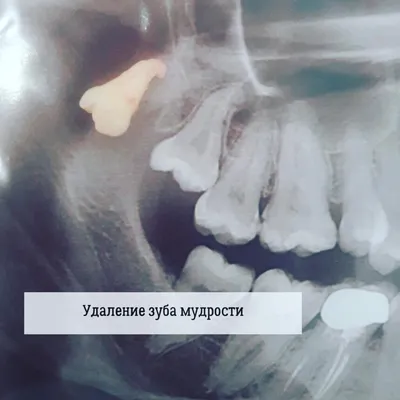 Удаление зубов мудрости в Москве недорого – цены, отзывы на операцию в  стоматологических клиниках Зуб.ру