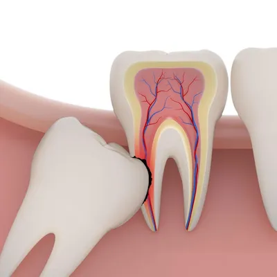 Нужно ли удалять зубы мудрости если болит зуб мудрости: мнение стоматолога