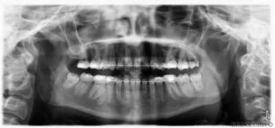 Удаление зубов перед установкой брекетов: зачем проводят — D.Ante