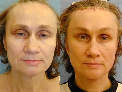 Как выглядит подтяжка нитями в фото До и После - Cosmetic-clinic
