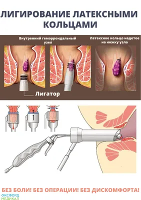 Лечение геморроя лигированием латексными кольцами в Житомире - медицинский  центр Оксфорд Медикал
