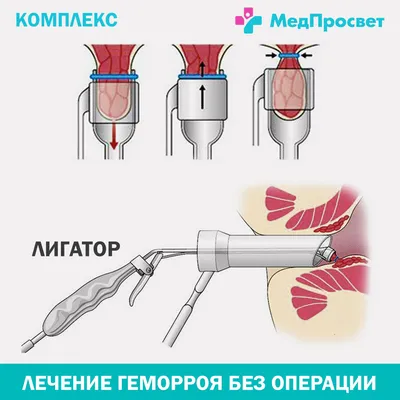 Лигирование геморроя в Ярославле. Цена удаления геморроидальных узлов латексными  кольца - Клиника Константа LIFE