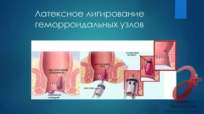 Малоинвазивные / малотравматичные технологии в лечении геморроидальной  болезни