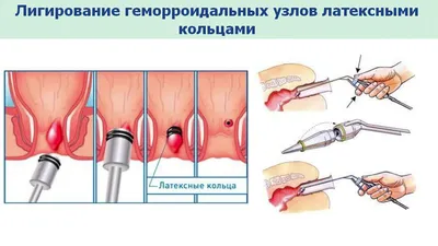 Лигирование геморроя в Ярославле. Цена удаления геморроидальных узлов латексными  кольца - Клиника Константа LIFE