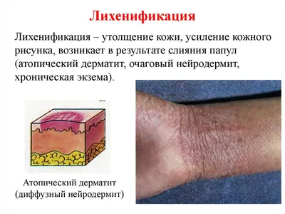 Проблемы кожи у детей – почему возникают сыпи, мокнутия, шершавость и  прочие проблемы | О детском здоровье: с врачебного на родительский | Дзен